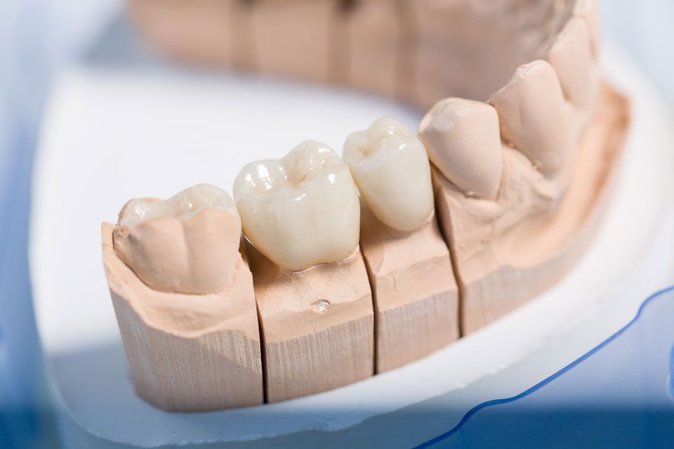 Dental Materialien – Vollkeramikkronen aus Lithiumdisilikat