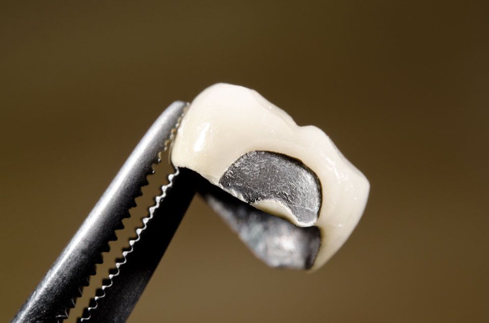 Verblendkeramik in der Zahnprothetik – Was ist das?